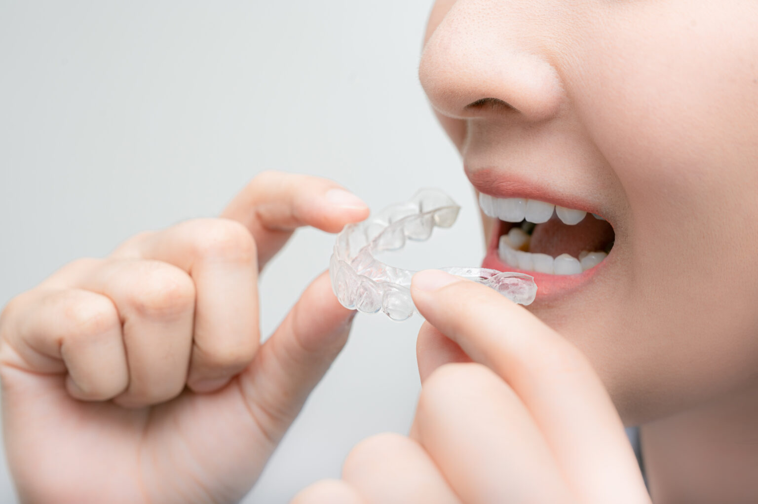 Learn About Orthodontic Clear Aligners Prairie Village Ks