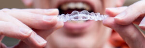 Man holding clear aligners