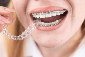 Prairie Village, KS, Clear Aligners