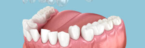 prairie village clear aligners