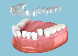 prairie village clear aligners