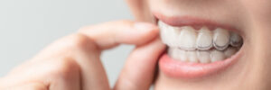prairie village removable aligners