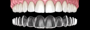 prairie village clear aligners