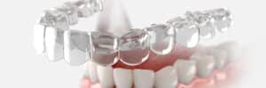 prairie village clear aligners
