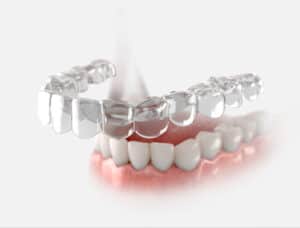 prairie village clear aligners